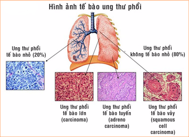 đầu bếp thuộc top những nhóm nghề có nguy cơ mắc ung thư phổi cao nhất hiện nay